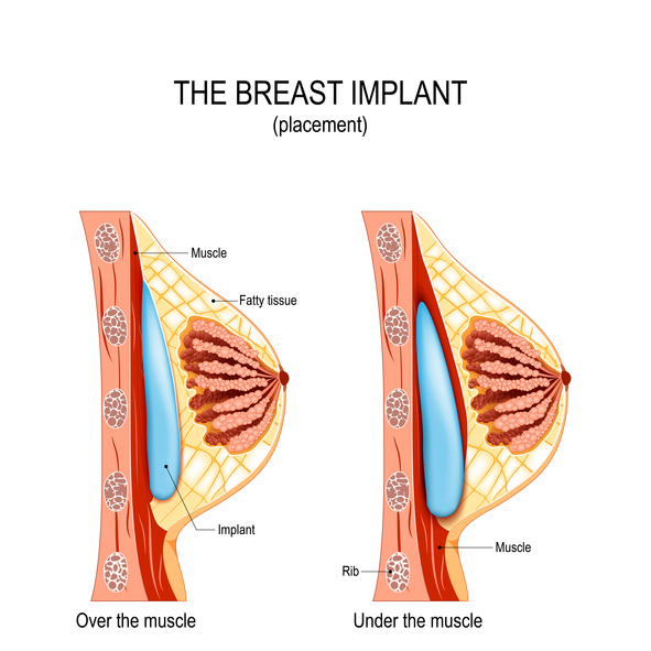 Breast Augmentation Lancaster