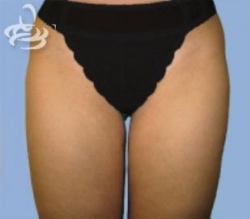 Liposuction Before and After | Valencia Plastic Surgery
