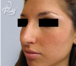 Rhinoplasty Before and After | Valencia Plastic Surgery